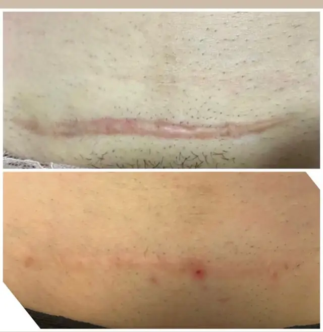 Cicatriz de cesárea antes e depois do tratamento