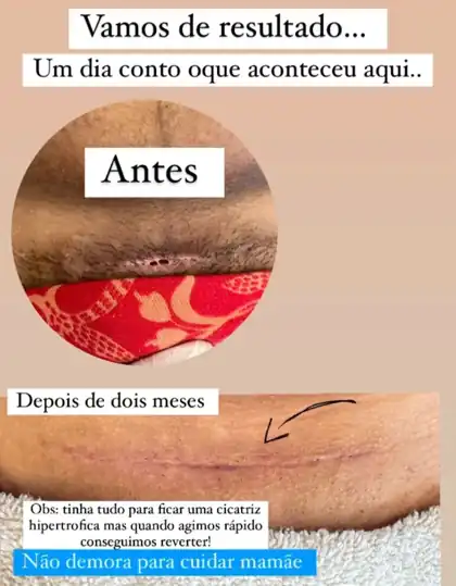 Cicatriz de cesárea antes e depois de dois meses