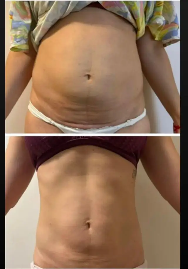 Barriga antes e depois
