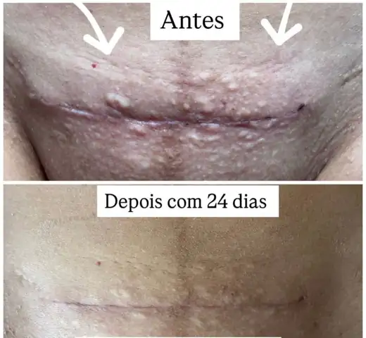 Cicatriz de cesárea antes e depois de 24 dias